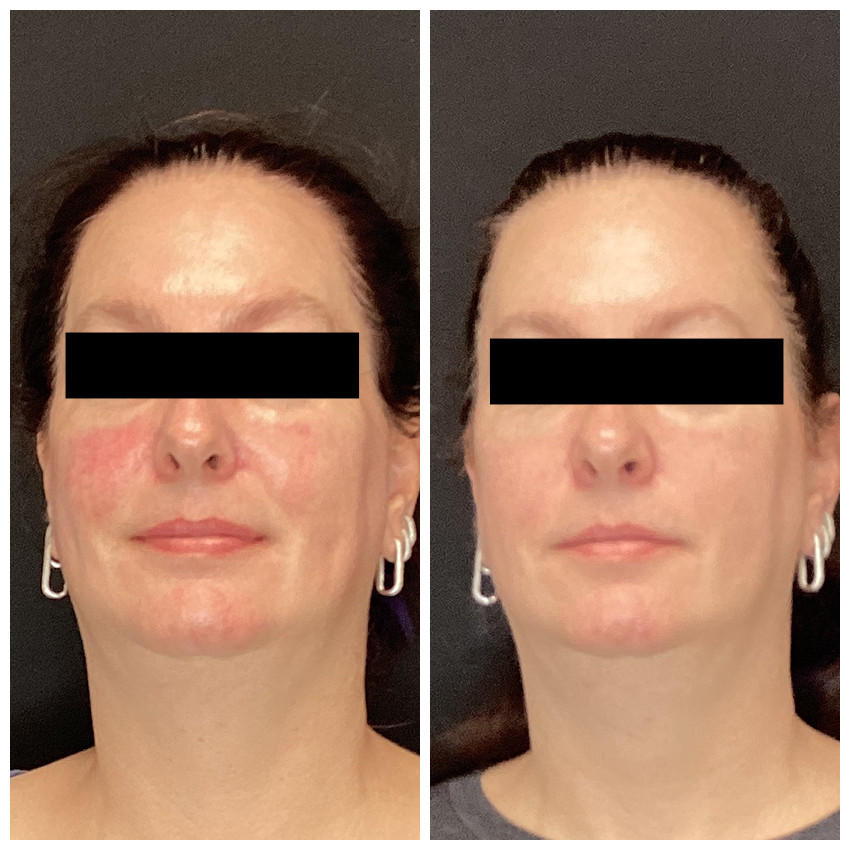 Rosacea Laser Treatment Before & After Michigan