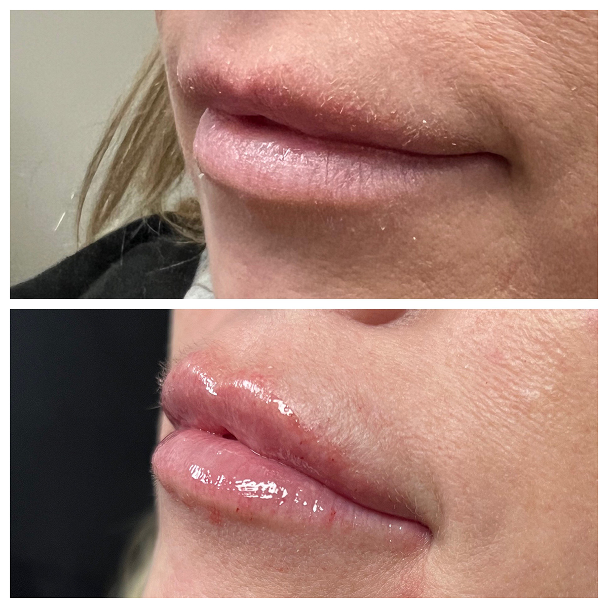 Dermal Filler Medical Spa Livonia Farmington Bloomfield Hills MI