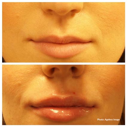 Meidcal Spa Michigan Dermal Fillers Juvederm