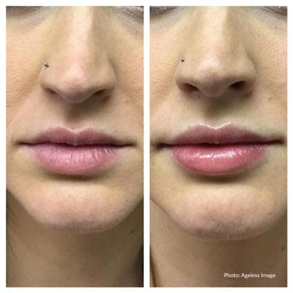 Dermal Filler Nurse Practioner Near Me Berkley Royal Oak