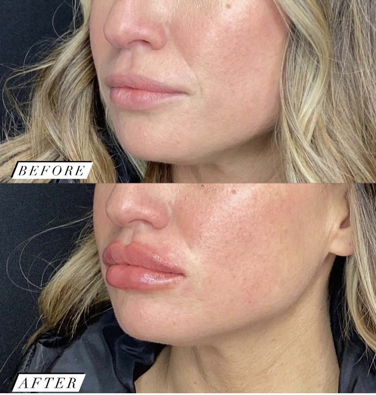 Dermal Filler Berkley MI