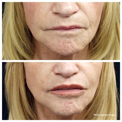 Dermal Filler Medical Spa Livonia Farmington Bloomfield Hills MI