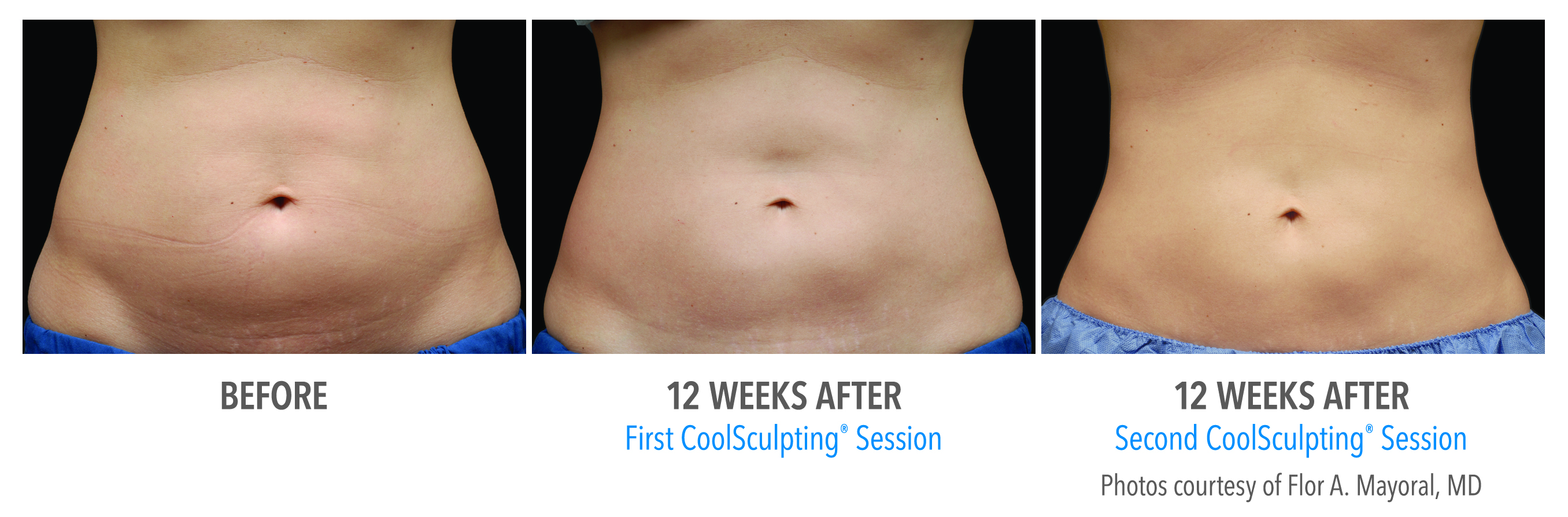 Farmington MI CoolSculpting Bloomfield Hills Freeze Fat